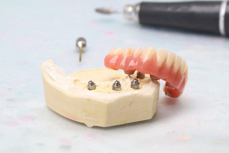 Modell Feste Dritte Zähne auf vier Implantaten