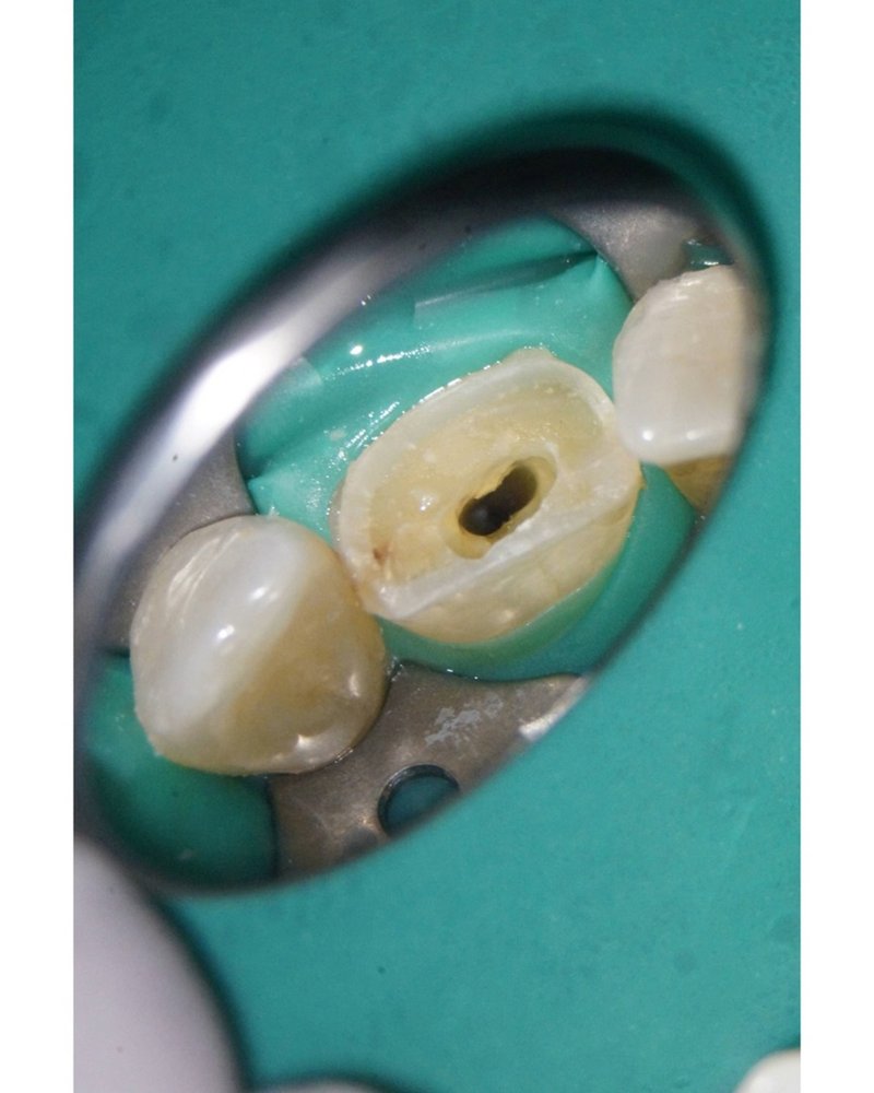 Wurzelkanal unter dem Mikroskop dargestellt