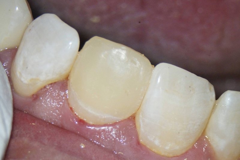 Kompositaufbau vestibulär