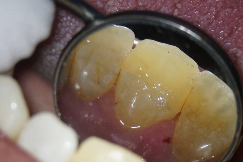 Kompositaufbau palatinal