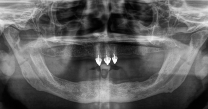 Röntgen Bissrehabilitation OPG nach Erstbefund