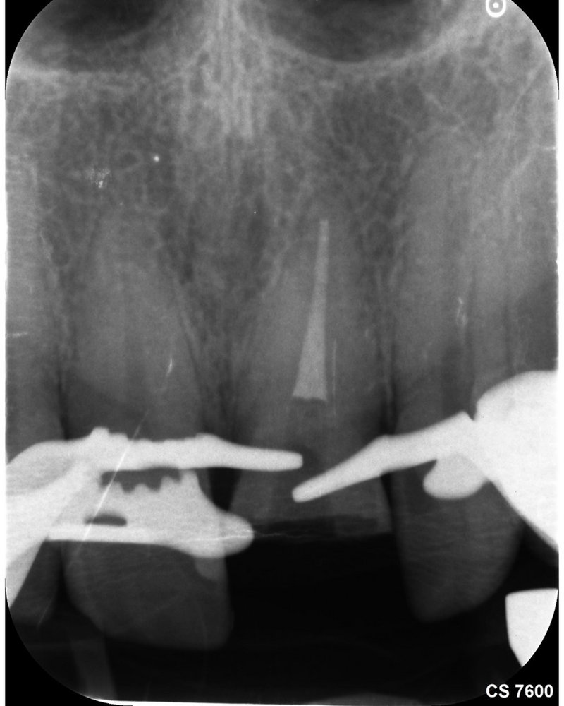 Röntgenkontrolle der Wurzelkanalfüllung