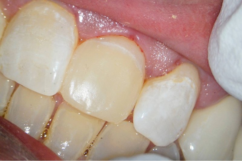 Kompositaufbau mit Gegenbiss