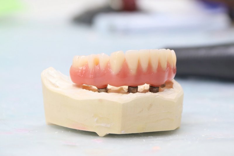 Modell Feste Dritte Zähne auf vier Implantaten
