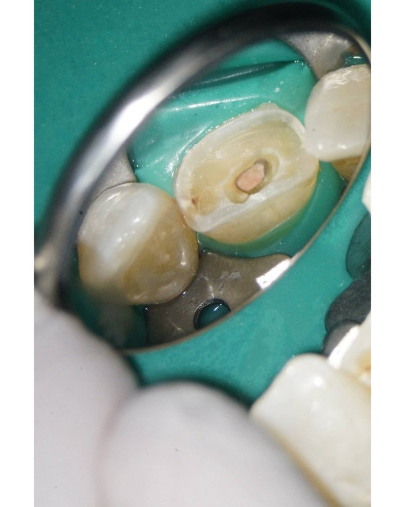 Wurzelkanal gefüllt in Continuus Wave Technik und Backfill, dargestellt unter dem Mikroskop