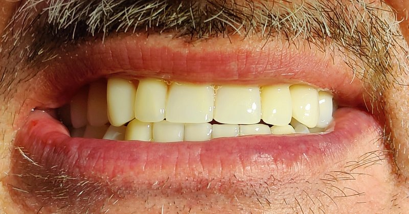 Lächeln nach Bissrehabilitation