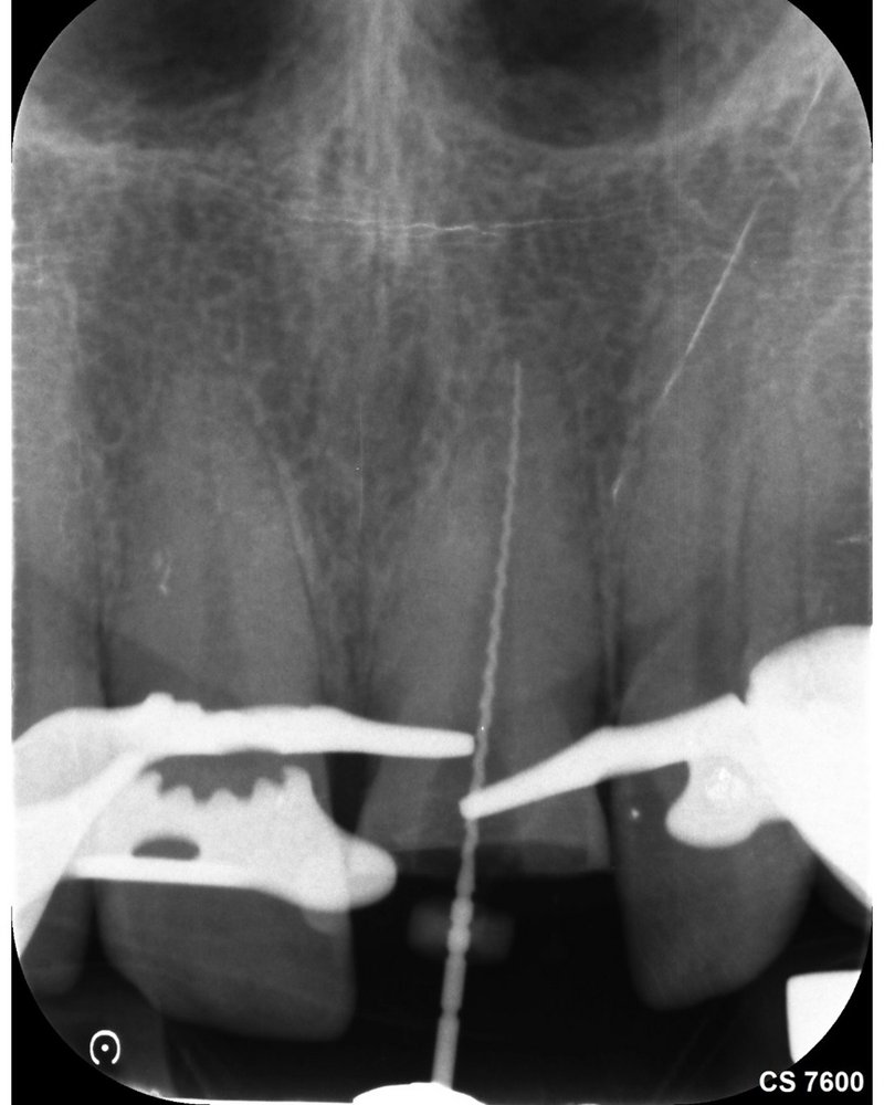 Kontrastaufnahme zur Längenbestimmung des Wurzelkanals
