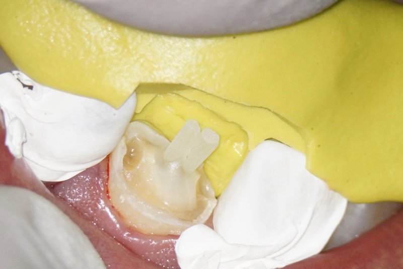 Wurzelkanalfüllung mit doppeltem Stiftaufbau