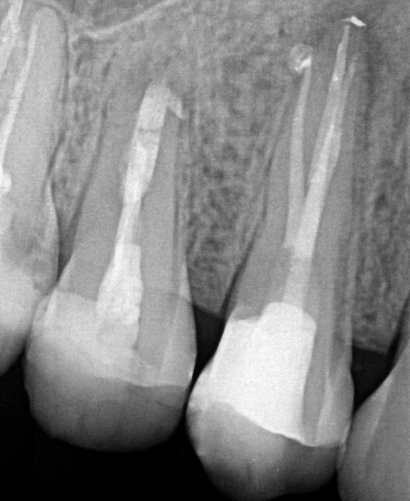 Röntgen Zahnwurzel Glasfaserschrift