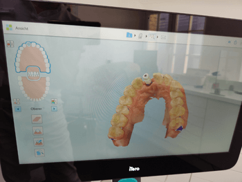 Frontzahnimplantat Intraoralscan