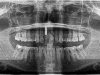 Röntgen Frontzahnimplantat OPG nach Implantation