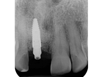 Röntge Frontzahnimplantat Zahnfilm nach Osteointegration