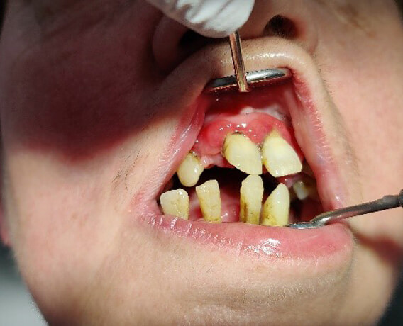 Genau mein Fall Gebiss vor Behandlung 